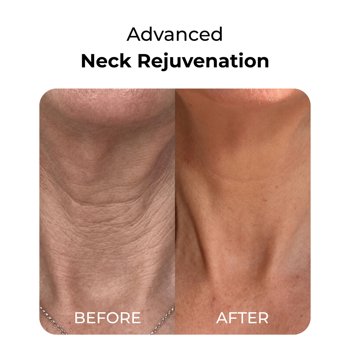 LED Face & Neck Light Therapy Mask for Wrinkles