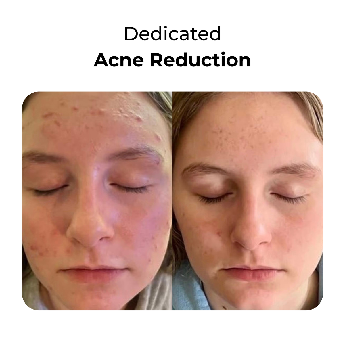 LED Face & Neck Light Therapy Mask for Wrinkles