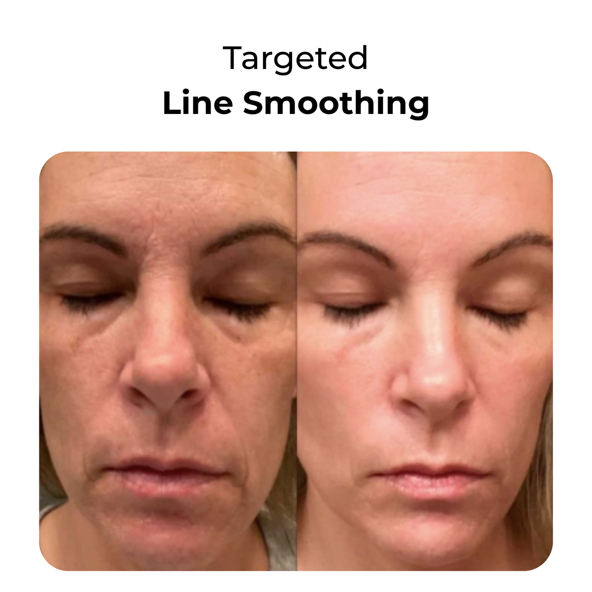 LED Face & Neck Light Therapy Mask for Wrinkles